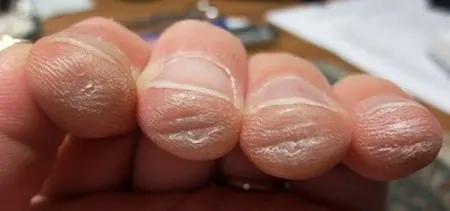 guitarist fingers with calluses