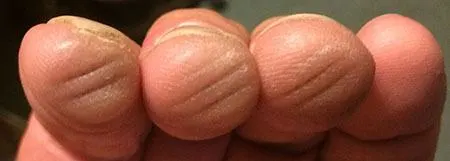 callused guitar fingers