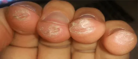 rough guitar callus