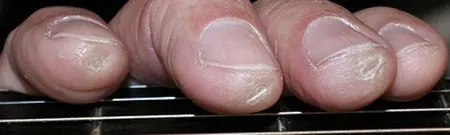 small fingertip calluses